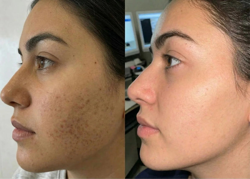 Cyperus Rotundus Skin Serum - Stop Unwanted Hair Growth Naturally - [Buy 1 Get 1 Free]